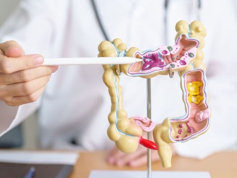 Tratamento de Diverticulite em Curitiba