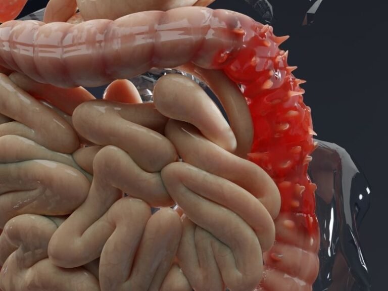 Tratamento de Doencas do Esofago em Curitiba