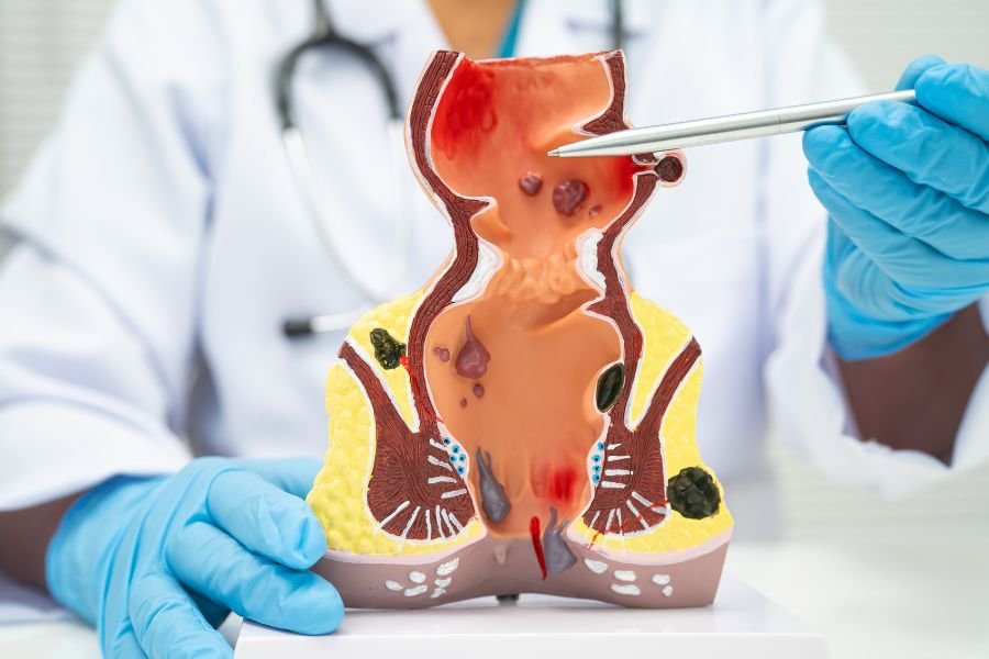 Infeccao Fungica Anal em Curitiba Diagnostico e Tratamento Especializado