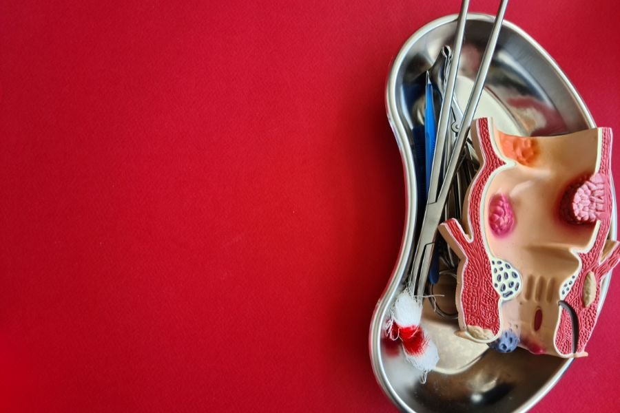 Plicoma Anal com Infeccao Fungica Como Tratar a Coceira e o Inchaco em Curitiba