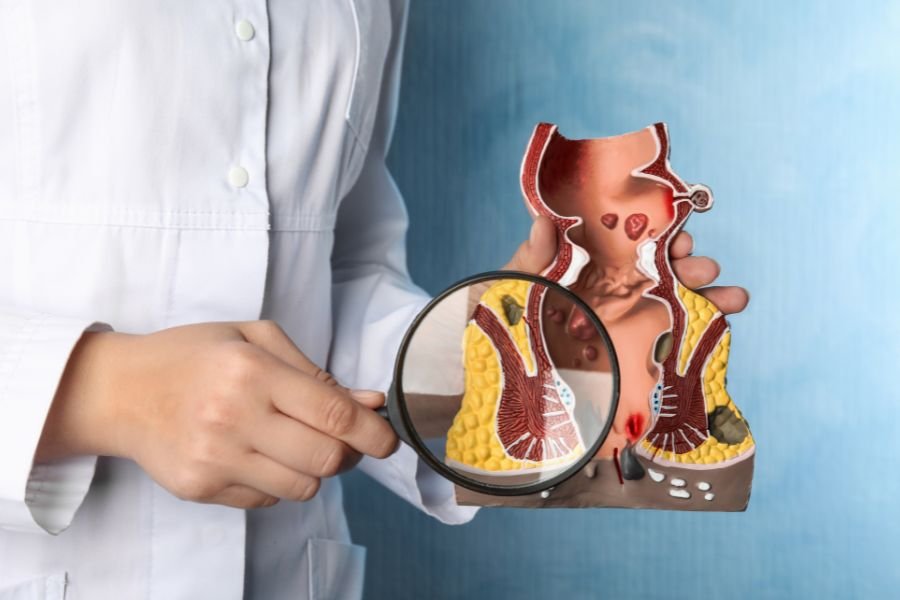 Sangramento Anal em Curitiba O que pode ser e como tratar